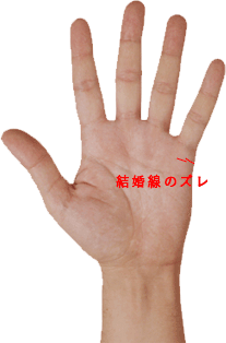占い 手相　結婚線　ずれ